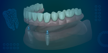 Implant Supported Overdenture, removable (with 2 implants) **